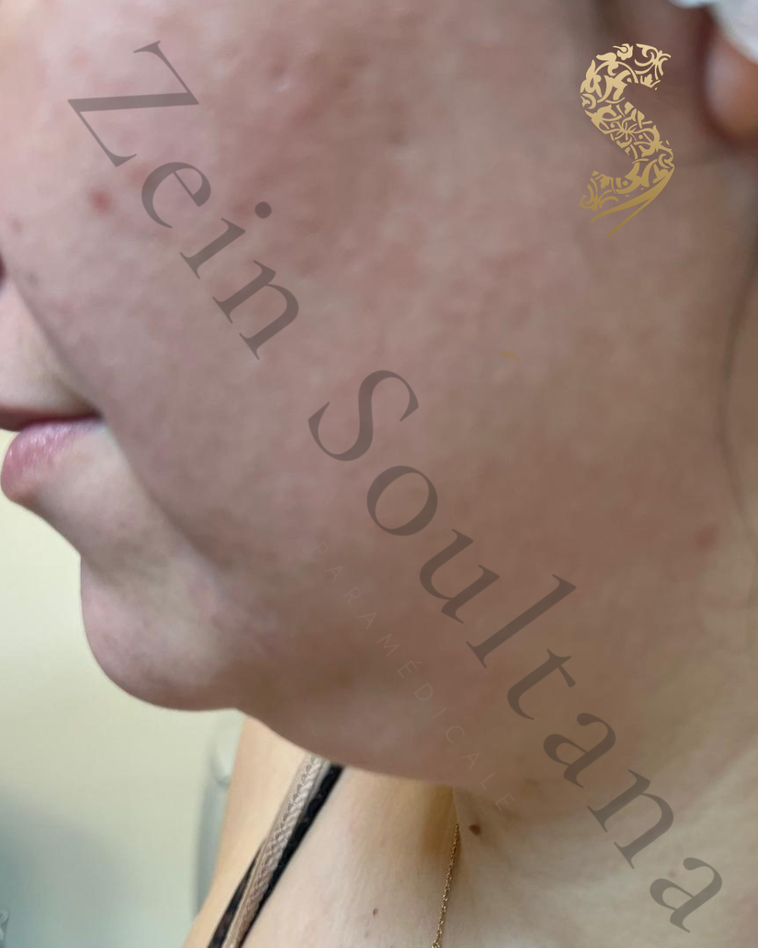 Avant HIFU visage Casablanca Dakhla