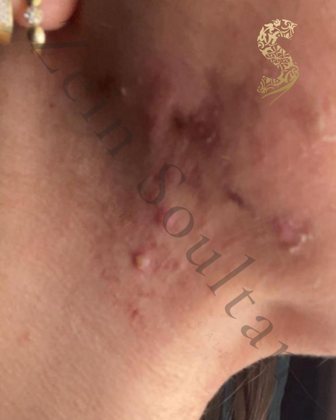 Avant microneedling Casablanca Dakhla