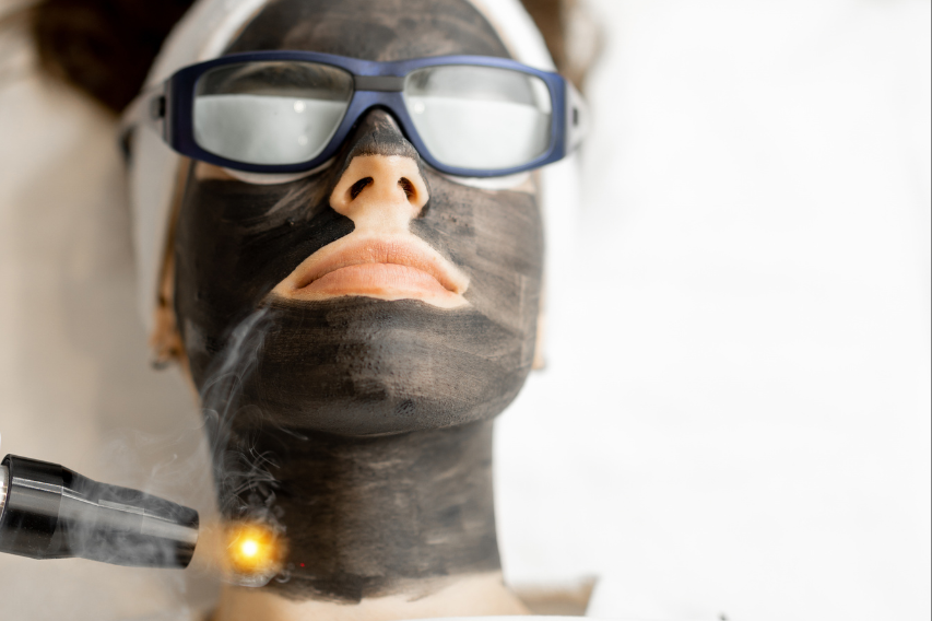 Carbon Peel esthétique paramédicale Casablanca Dakhla
