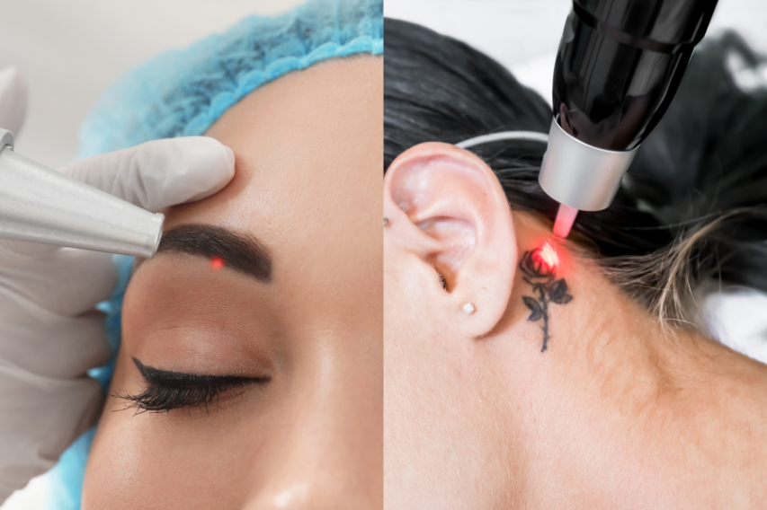 Détatouage laser soins esthétiques Casablanca Dakhla - Effacement tatouage