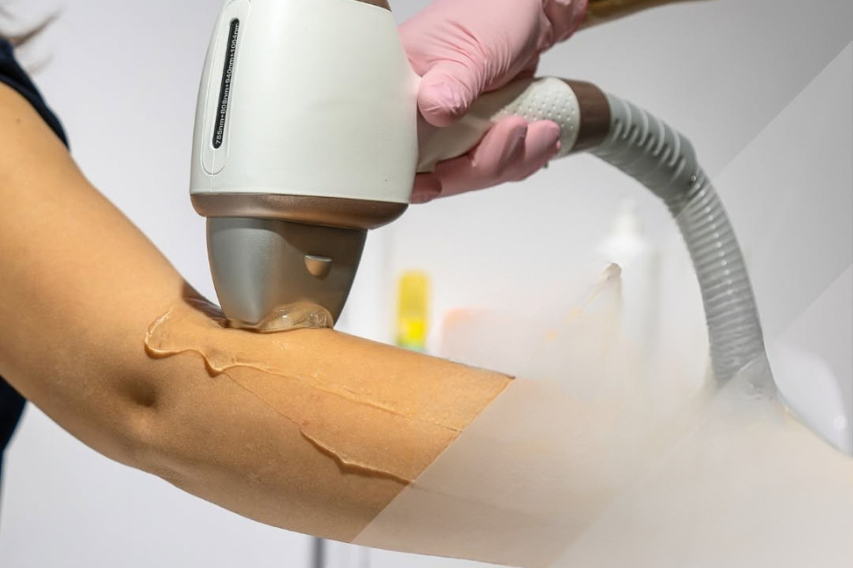 Épilation laser Casablanca Dakhla - Séance en cours au centre Zein Soultana