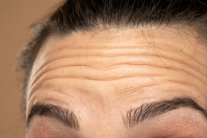 Microneedling Casablanca Dakhla - Séance en cours au centre Zein Soultana