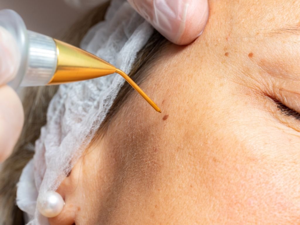 Plasma Pen soins esthétiques Casablanca Dakhla - Raffermissant