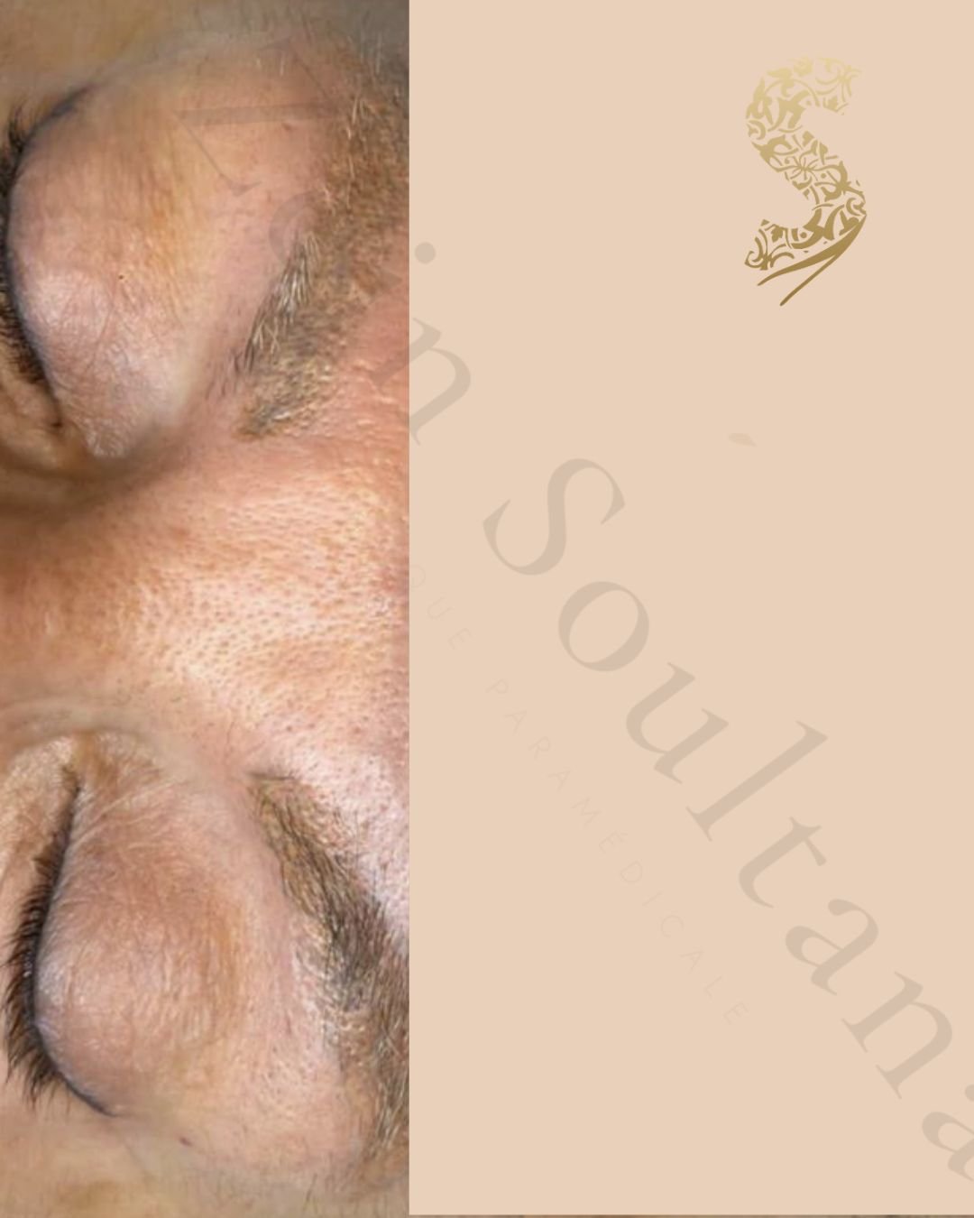 Après détatouage laser Casablanca Dakhla