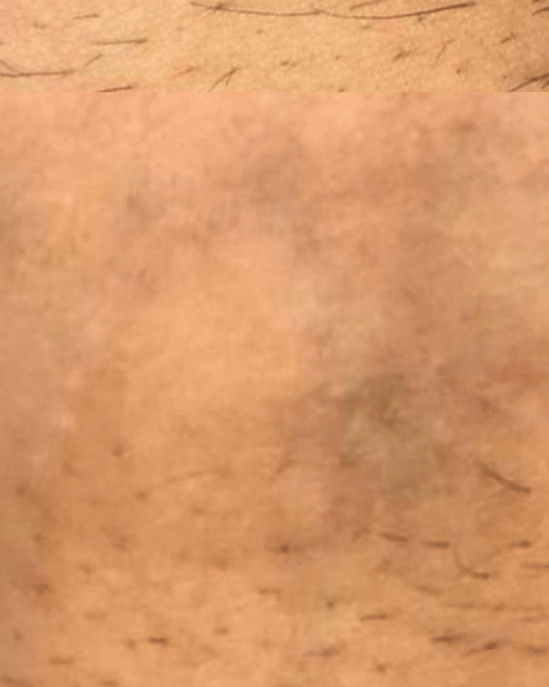 Après détatouage laser Dakhla