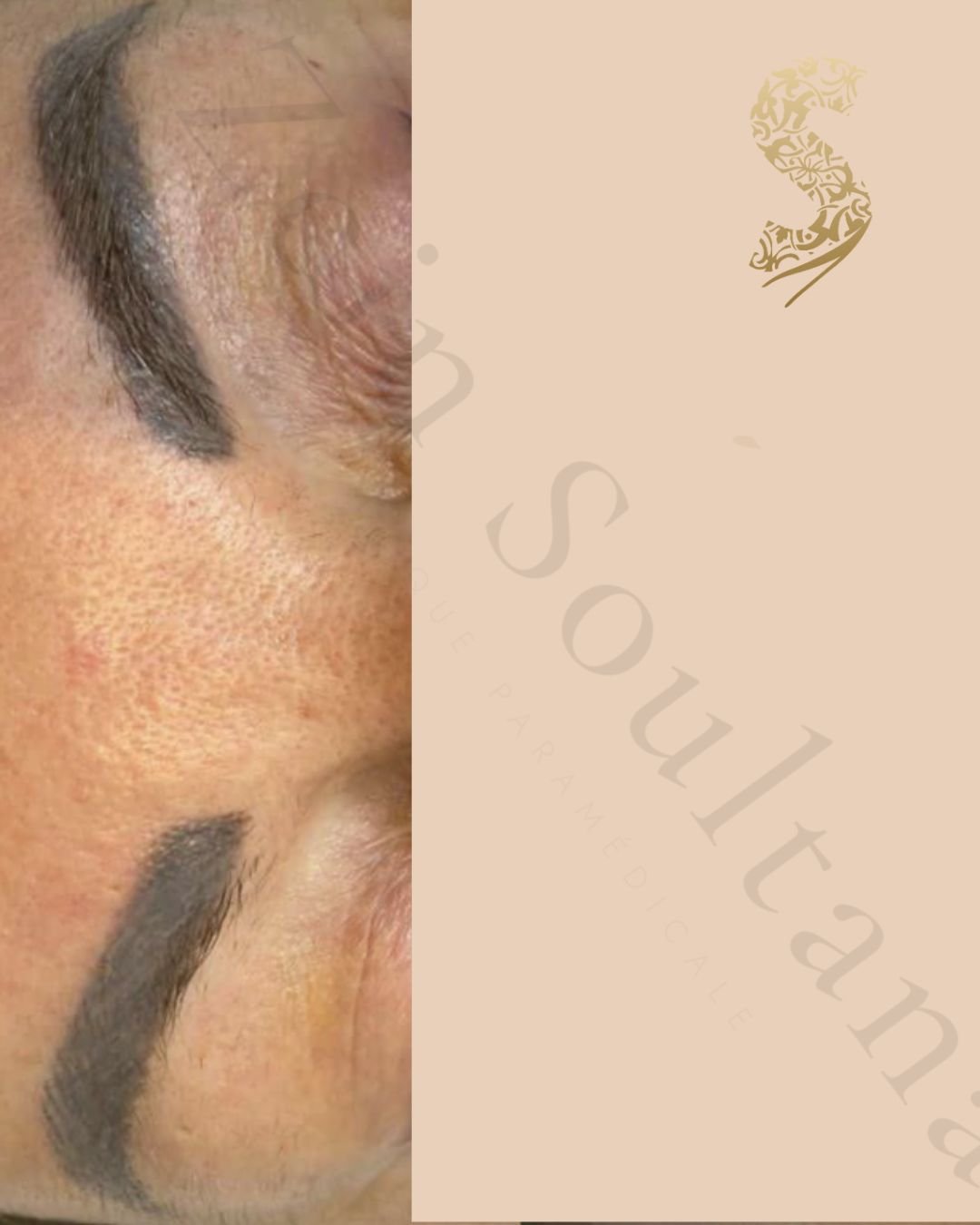 Avant détatouage laser Casablanca Dakhla