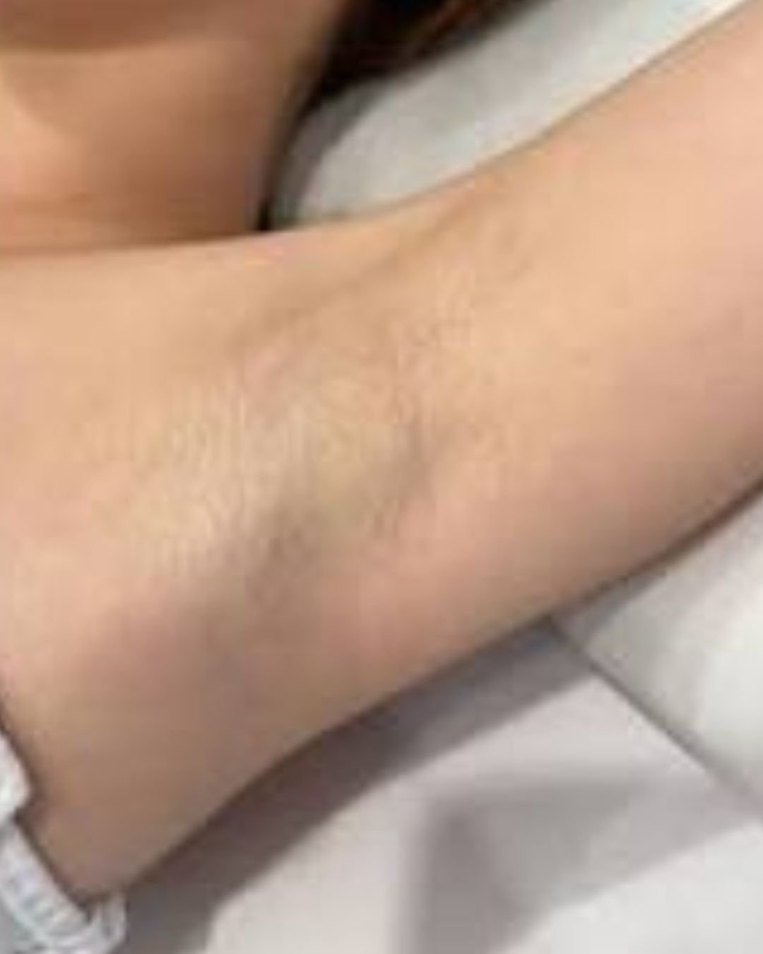 Après épilation laser aiselles Casablanca Dakhla