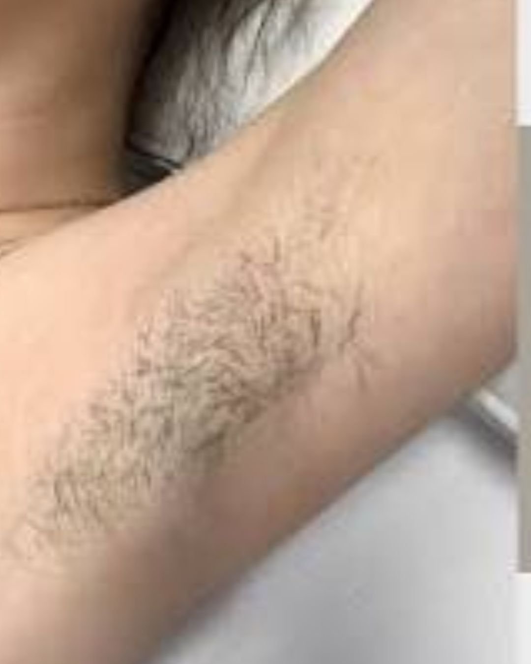 Avant épilation laser jambes Casablanca Dakhla