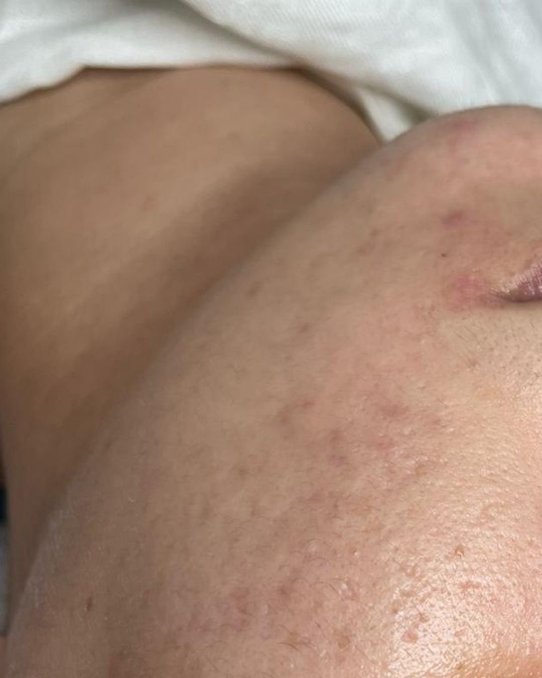 Après Hydrafacial Casablanca Dakhla - Peau acnéique