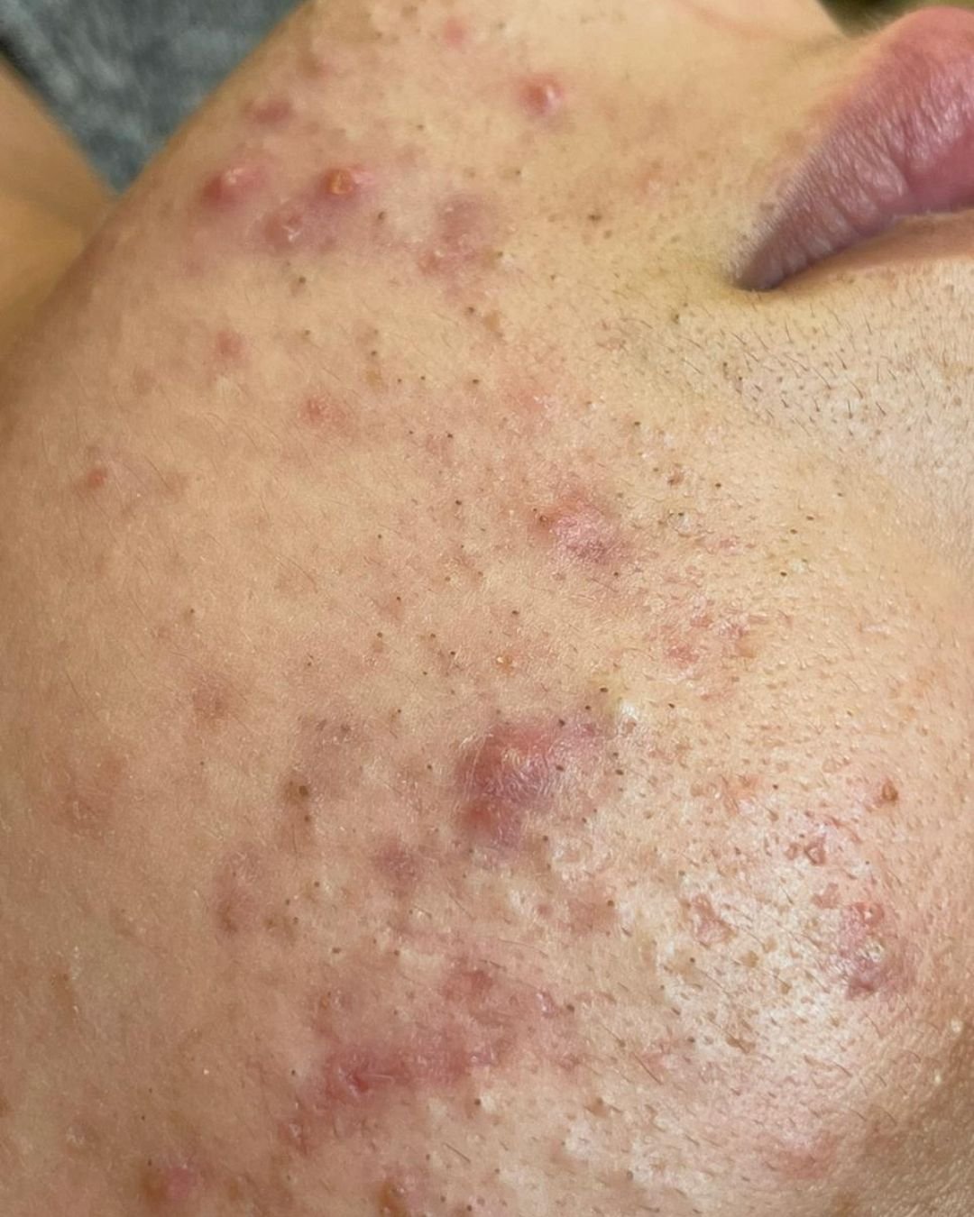 Avant Hydrafacial Casablanca Dakhla - Peau terne