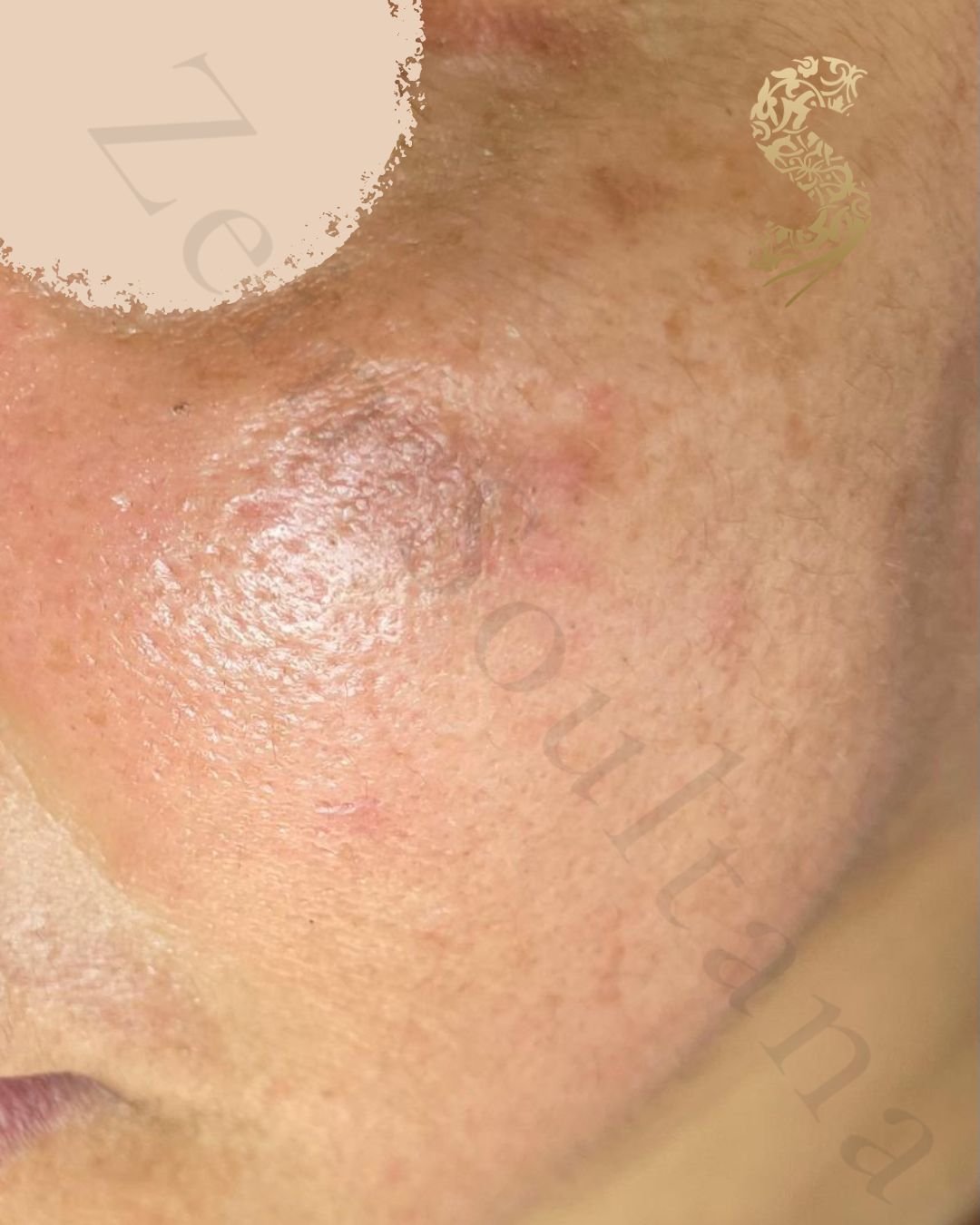 Après Carbon Peel Casablanca Dakhla - Peau nette
