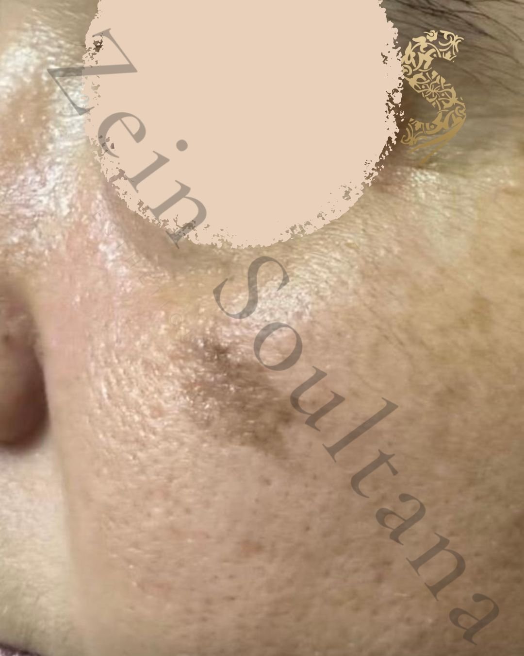Avant Carbon Peel Casablanca Dakhla - Peau grasse