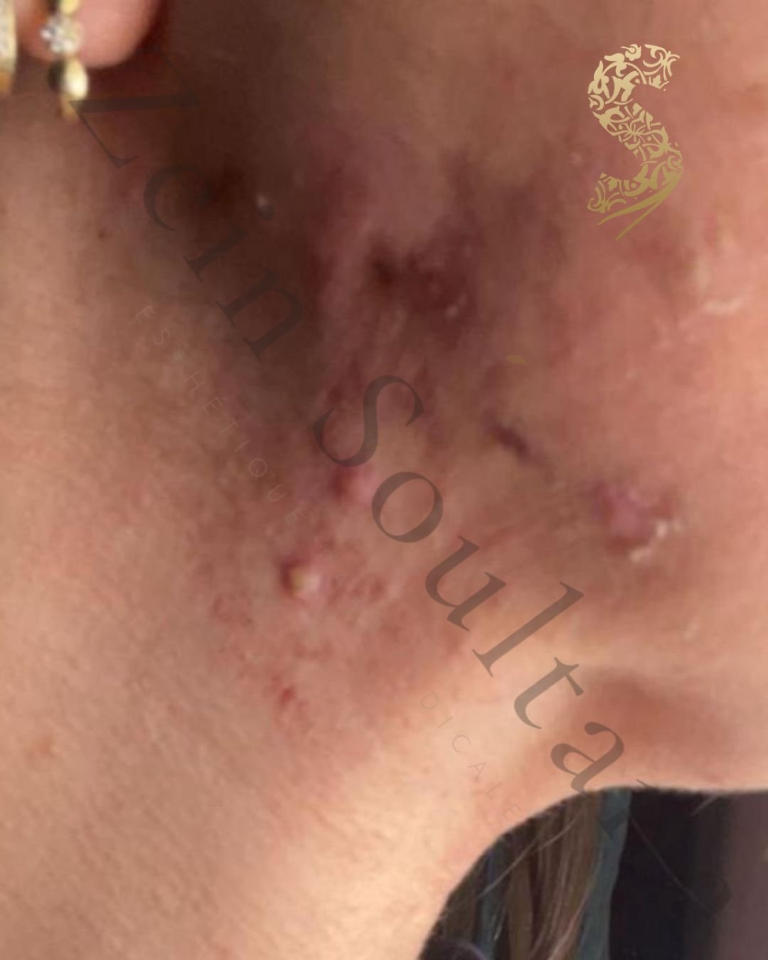 Résultats esthétiques Casablanca Dakhla avant microneedling rides